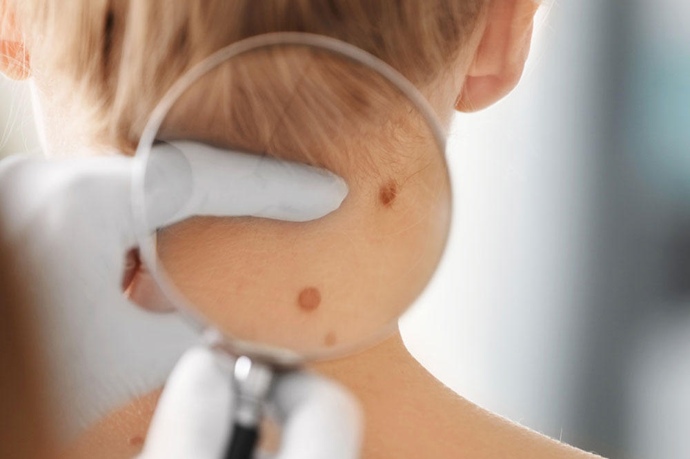 Ways to Prevent and Treat the Signs of Melanoma